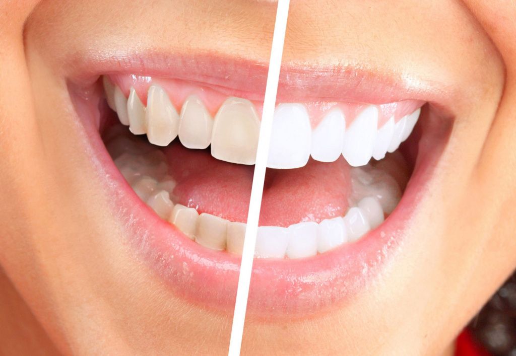 otbelivanie-zubov-beyond-07.jpg