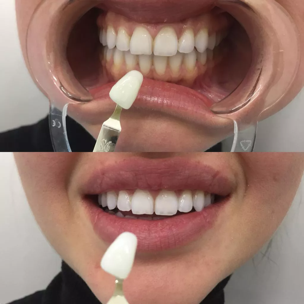 Безопасные методы отбеливания зубов